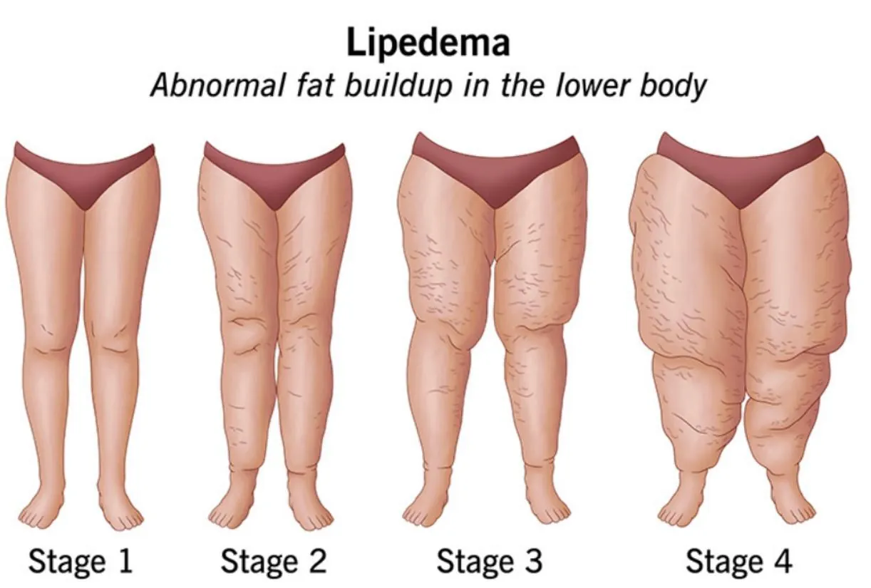 Lipœdème : répartition de la graisse sur les jambes