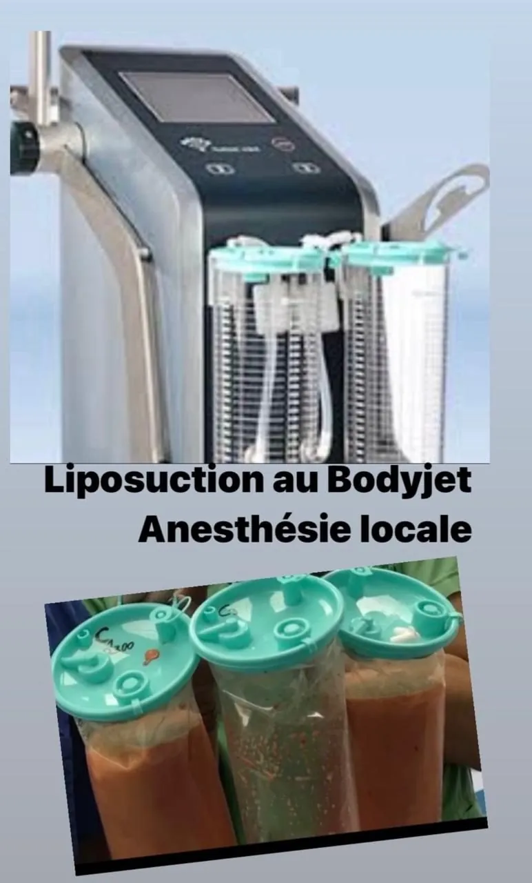 Appareil Body-Jet pour la liposuccion WAL sous anesthésie locale