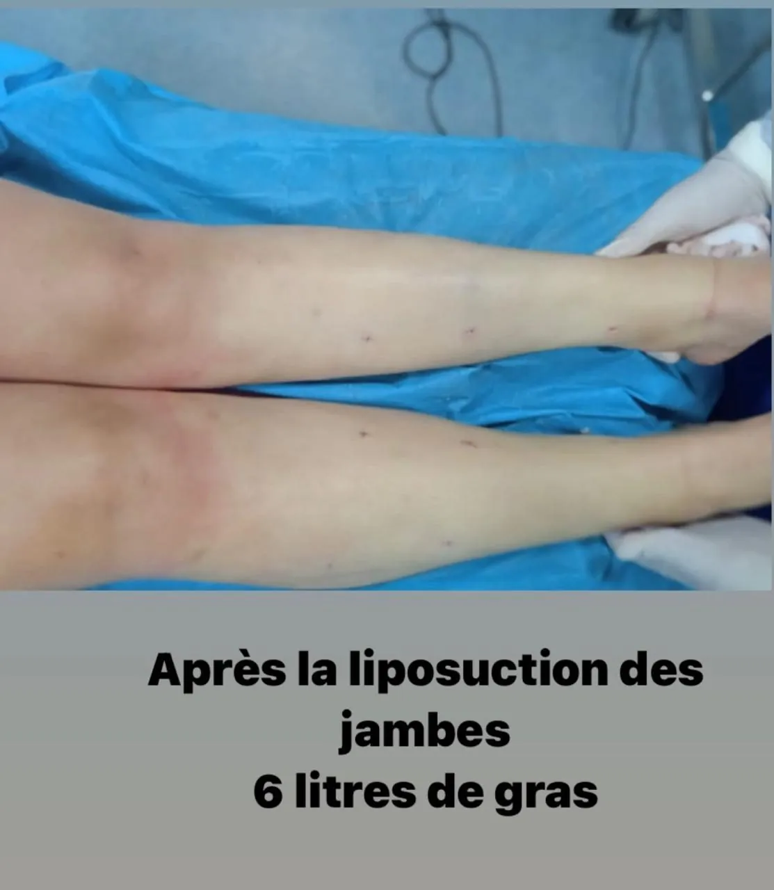 Jambes après une liposuccion du lipœdème