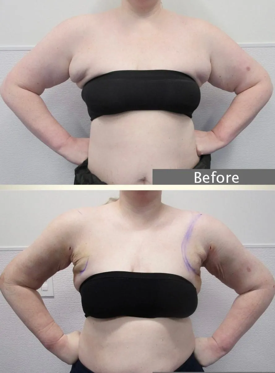 Lipœdème des bras avant et après liposuccion WAL