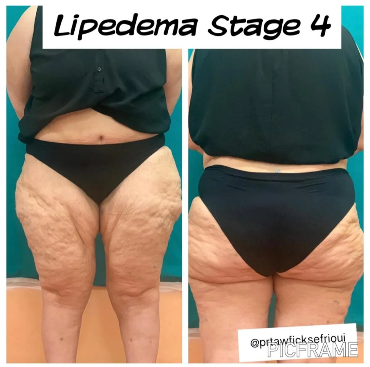 Lipœdème de stade avancé des jambes