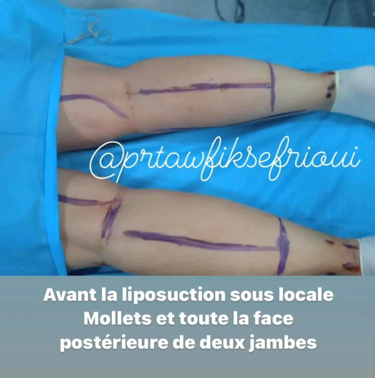 Marquage des zones à traiter avant une liposuccion du lipœdème des mollets